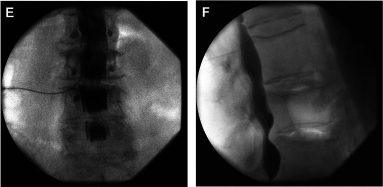 Epidural Contrast Patterns and Clinical Implications: An Educational Review.