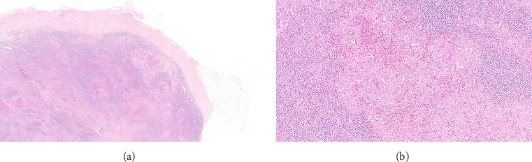 Unusual Long-Term Survival in an Adult Patient With Langerhans Cell Histiocytosis and Central Nervous System Involvement: A Case Report.