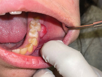 Young Female With Gingival Lesion of Intraoral Osseous Choristoma: A Rare Case Report.