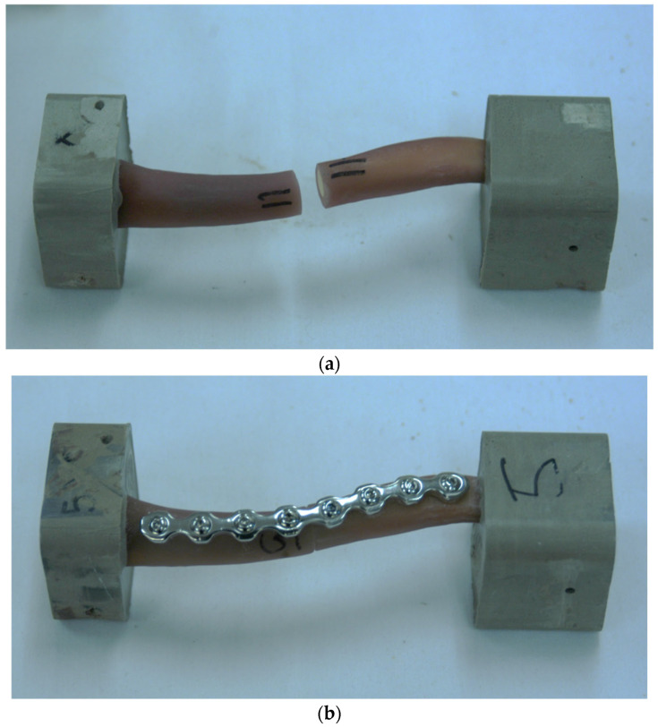 Unicortical Locking Screws Provide Comparable Rigidity to Bicortical Compression Screws in Tranverse Mid-Shaft Clavicle Fracture Plate Fixation Constructs.