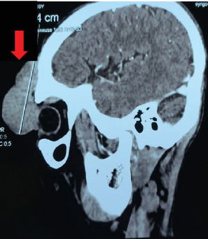 Dermatofibrosarcoma Protuberans of the Forehead: Case Report of a Rare Entity and Review of Literature.