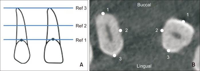 An effective approach to assessing inter-root distances using tooth models without repeated cone-beam computed tomography scans during orthodontic treatment.