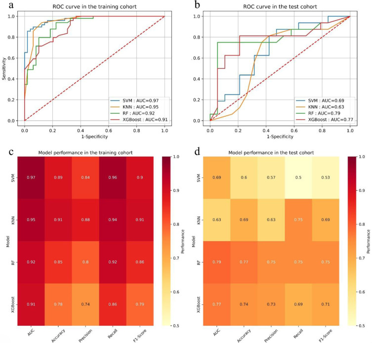 MRI Radiomics to Predict Early Treatment Response to TACE Combined with Lenvatinib Plus a PD-1 Inhibitor for Hepatocellular Carcinoma with Portal Vein Tumor Thrombus.