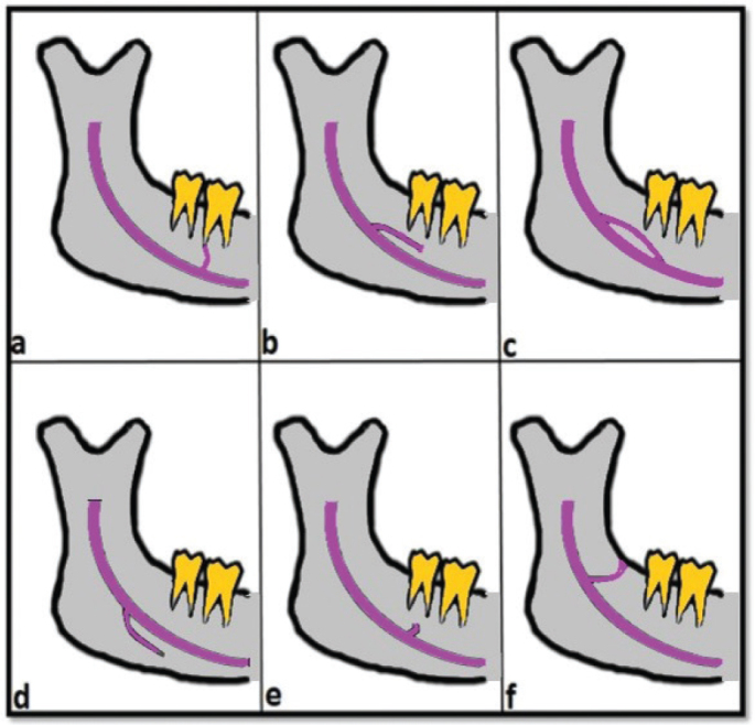 Is the presence of accessory mandibular canals associated with the dimensions of the mandibular canal?