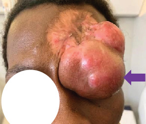 Dermatofibrosarcoma Protuberans of the Forehead: Case Report of a Rare Entity and Review of Literature.