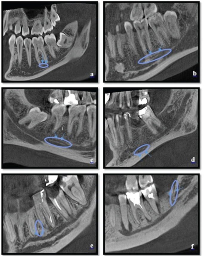 Is the presence of accessory mandibular canals associated with the dimensions of the mandibular canal?