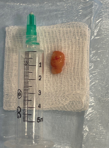 Young Female With Gingival Lesion of Intraoral Osseous Choristoma: A Rare Case Report.