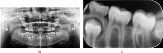 Young Female With Gingival Lesion of Intraoral Osseous Choristoma: A Rare Case Report.