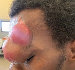 Dermatofibrosarcoma Protuberans of the Forehead: Case Report of a Rare Entity and Review of Literature.