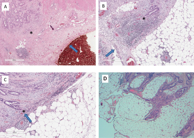 Peritoneal reflection involvement as a prognostic factor in rectal cancer. Long-term oncological outcomes from a prospective study.