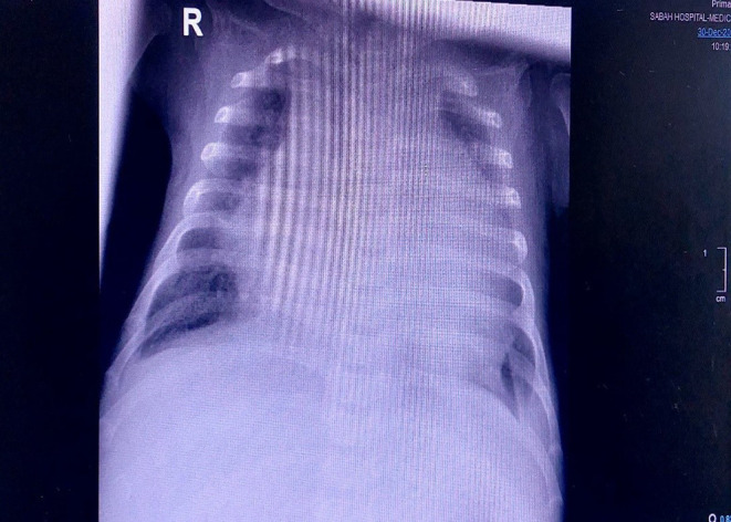 Congenital Acute Myeloid Leukemia (AML): A Case Report.