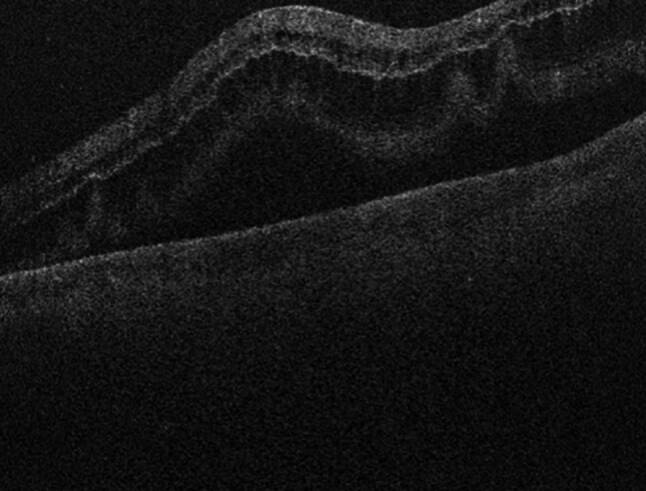 A review of rhegmatogenous retinal detachment: past, present and future.