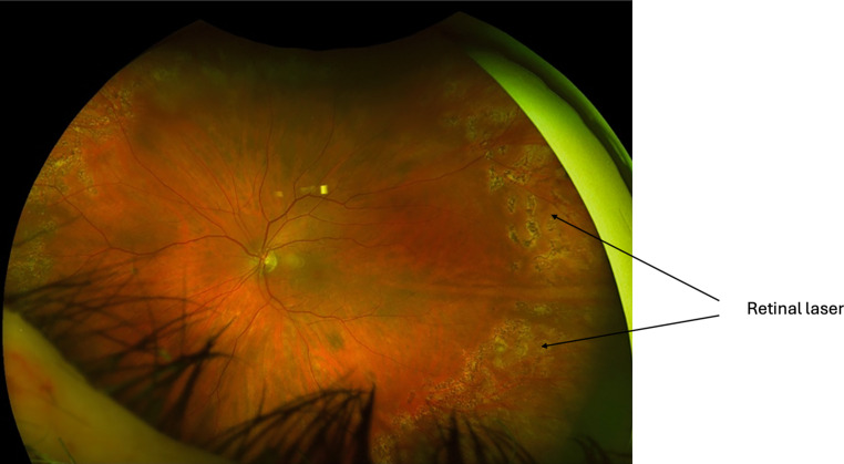A review of rhegmatogenous retinal detachment: past, present and future.