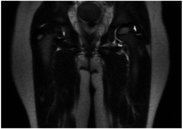 [Early diagnosis of a case of septic arthritis thanks to the BioFire® joint infection panel].