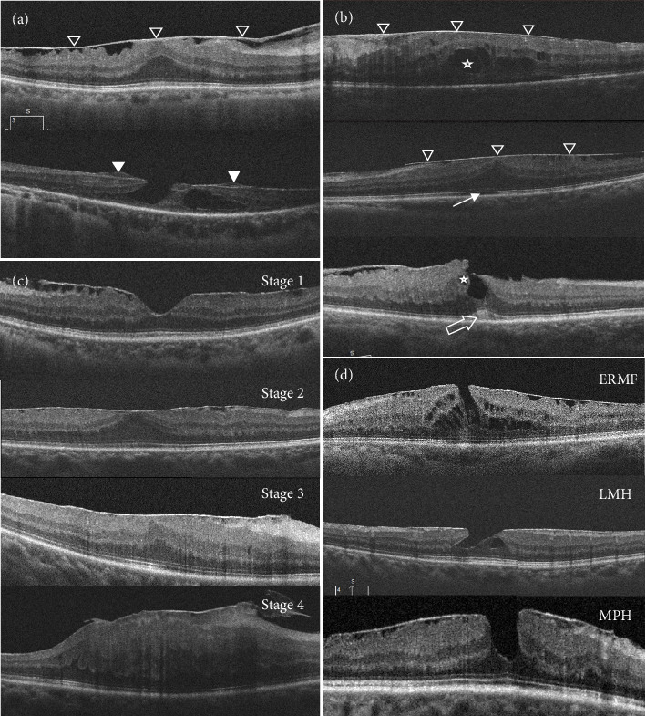 Optical Coherence Tomography Characteristics Between Idiopathic Epiretinal Membranes and Secondary Epiretinal Membranes due to Peripheral Retinal Hole.