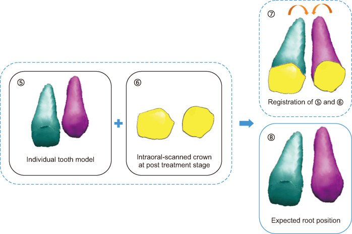 An effective approach to assessing inter-root distances using tooth models without repeated cone-beam computed tomography scans during orthodontic treatment.