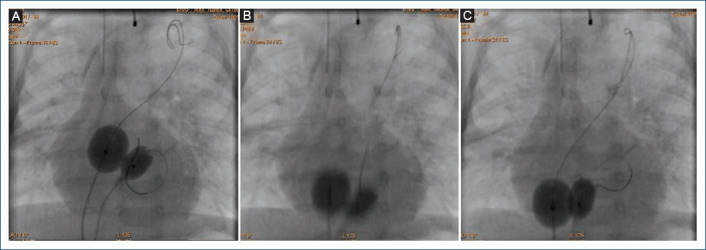 Double "dynamic" balloon atrial septostomy. New modification of Dr. Rashkind's technique for cases with thickened interatrial septum.