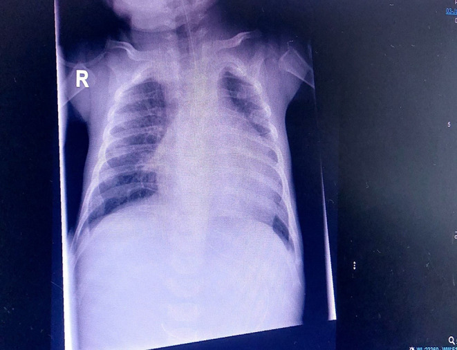 Congenital Acute Myeloid Leukemia (AML): A Case Report.