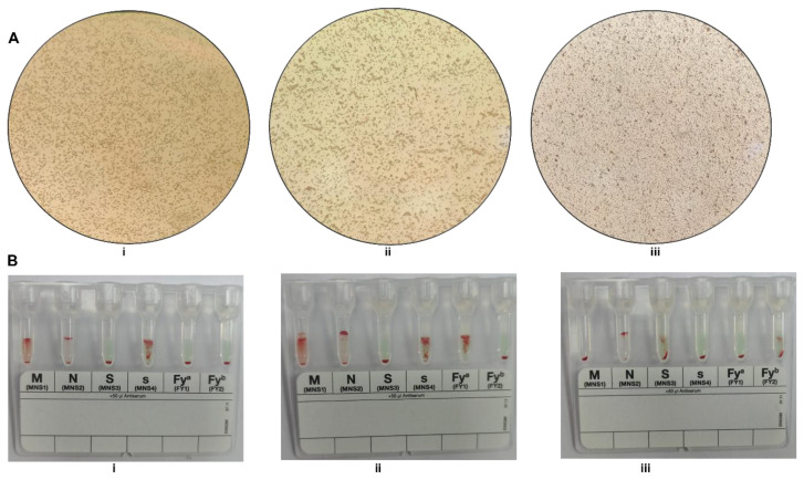 <i>Plasmodium vivax</i> Infections in Duffy-Negative Individuals: A Paradigm Shift in Indian Malaria Epidemiology.