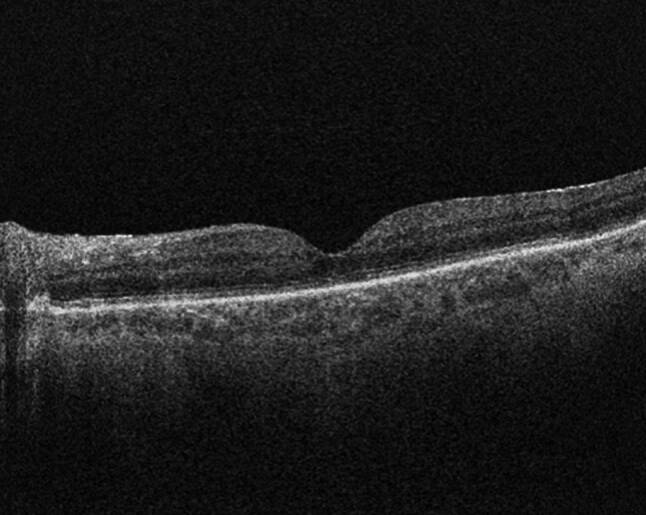 A review of rhegmatogenous retinal detachment: past, present and future.