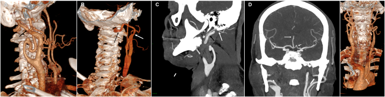 Unusual anatomical variations of cervical and cranial arteries with surgical interest: case report.