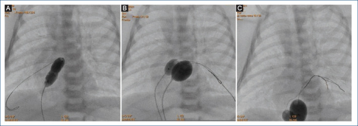 Double "dynamic" balloon atrial septostomy. New modification of Dr. Rashkind's technique for cases with thickened interatrial septum.
