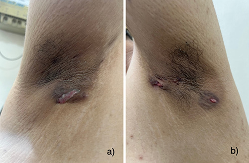 Nightmares caused by isotretinoin in treating hidradenitis suppurativa: a case report and clinical insights.