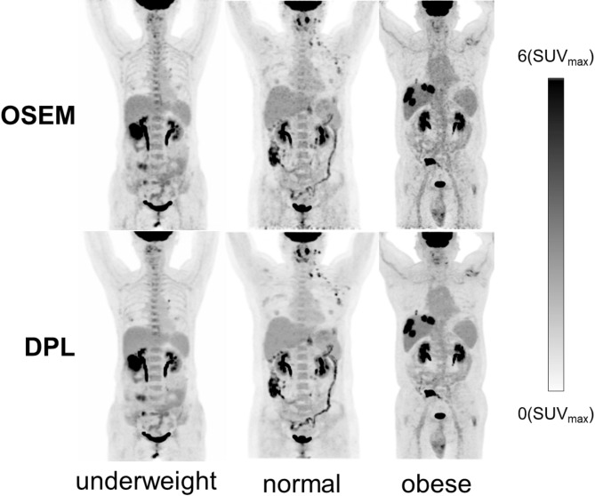 Enhancing <sup>18</sup>F-FDG PET image quality and lesion diagnostic performance across different body mass index using the deep progressive learning reconstruction algorithm.