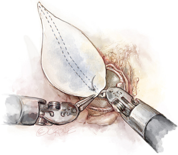 Advancing robotic aortic valve replacement beyond isolated therapy: a platform for multivalve therapy.