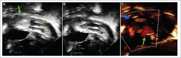 Double "dynamic" balloon atrial septostomy. New modification of Dr. Rashkind's technique for cases with thickened interatrial septum.
