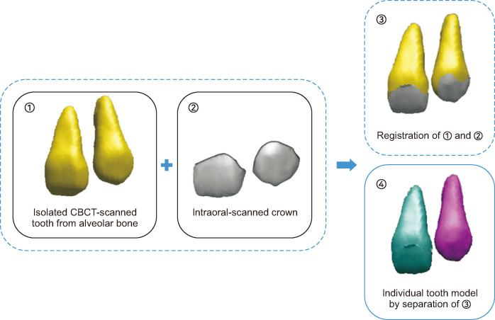 An effective approach to assessing inter-root distances using tooth models without repeated cone-beam computed tomography scans during orthodontic treatment.