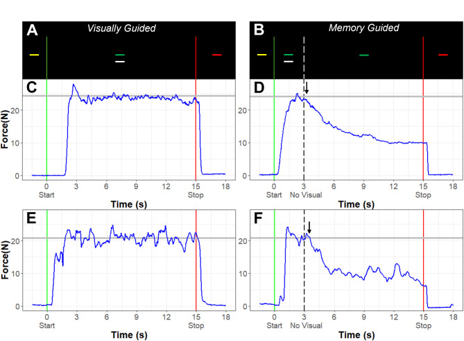 Visual feedback and motor memory contributions to sustained motor control deficits in autism spectrum disorder across childhood and into adulthood.