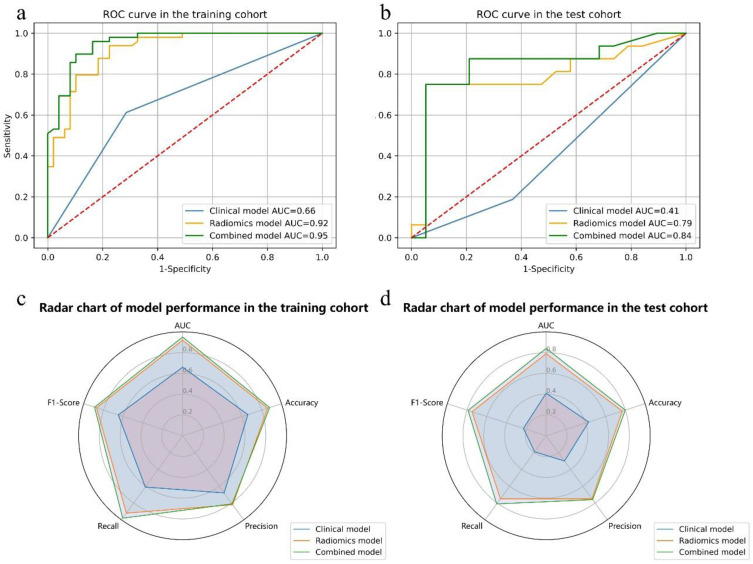 MRI Radiomics to Predict Early Treatment Response to TACE Combined with Lenvatinib Plus a PD-1 Inhibitor for Hepatocellular Carcinoma with Portal Vein Tumor Thrombus.