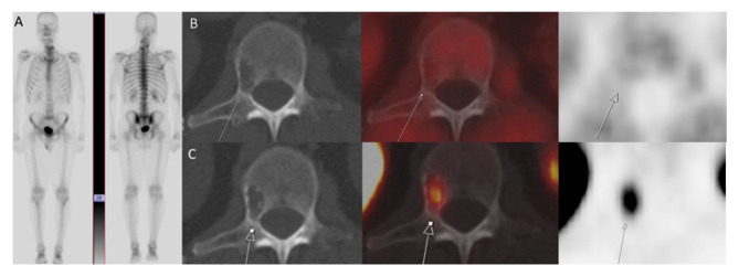 PSMA-expressing, fluciclovine-negative vertebral hemangioma.