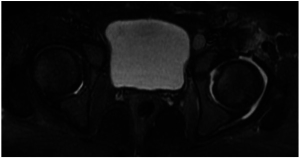 [Early diagnosis of a case of septic arthritis thanks to the BioFire® joint infection panel].