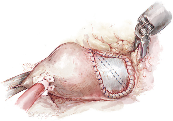Advancing robotic aortic valve replacement beyond isolated therapy: a platform for multivalve therapy.