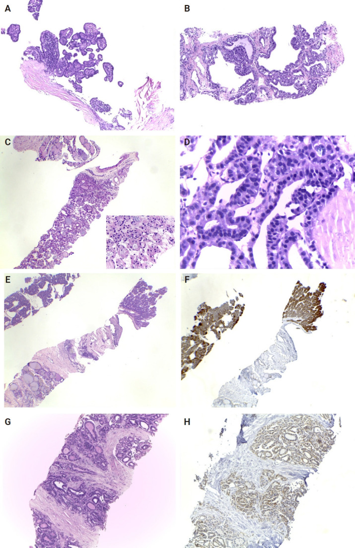 Lessons learned from the first 2 years of experience with thyroid core needle biopsy at an Indonesian national referral hospital.