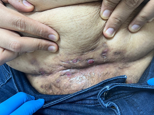 Nightmares caused by isotretinoin in treating hidradenitis suppurativa: a case report and clinical insights.