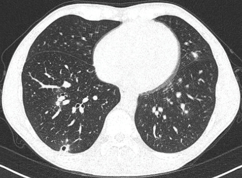 Acute histoplasmosis in four immunocompetent Canadian travellers to a cenote in Yucatán, Mexico.