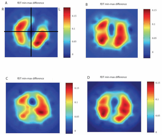 Ventilation distribution in mechanically ventilated children in response to positioning: An exploratory study.