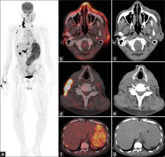 Rare Metastases to Liver and Spleen form a Seldom Case of Facial Angiosarcoma Demonstrated on Staging FDG PET-CT.