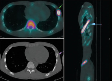 Banana-like Appearance of Rib Fibrous Dysplasia in Bone Scintigraphy and Single-Photon Emission Computed Tomography (SPECT).
