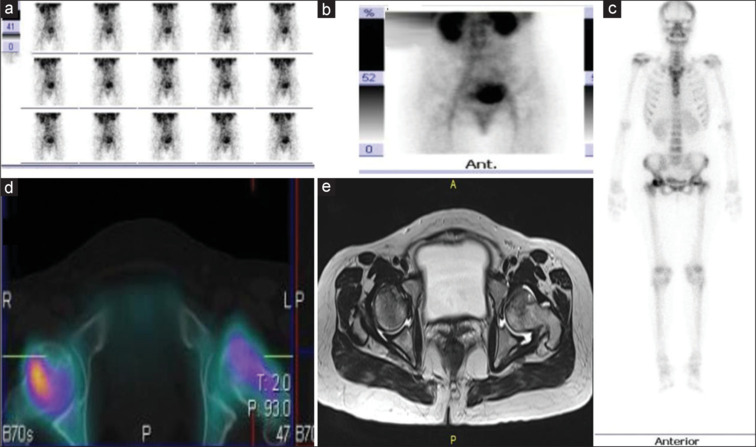 Utility of SPECT/CT in Non-Traumatic Osteonecrosis: Revisited with New Insights from a Prospective Diagnostic Study.