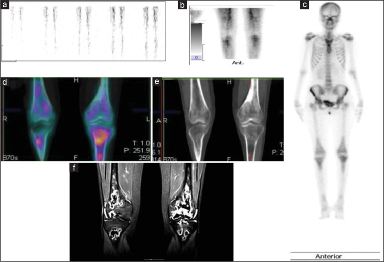 Utility of SPECT/CT in Non-Traumatic Osteonecrosis: Revisited with New Insights from a Prospective Diagnostic Study.