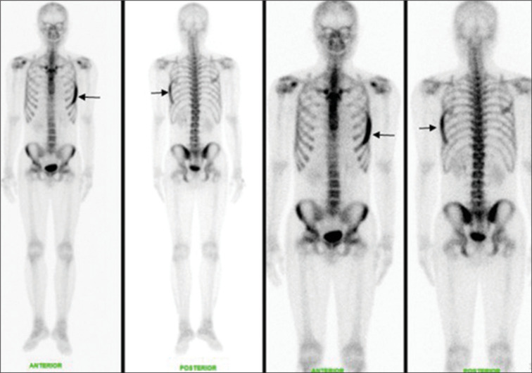 Banana-like Appearance of Rib Fibrous Dysplasia in Bone Scintigraphy and Single-Photon Emission Computed Tomography (SPECT).