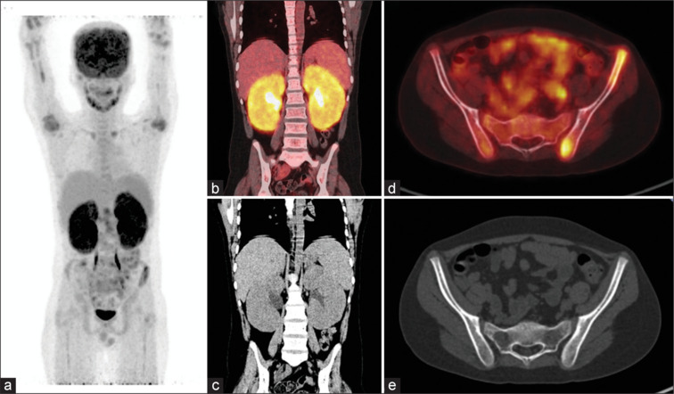 A Rare Case of <sup>18</sup>F-FDG-avid Renomegaly as the Initial Presentation of Acute Lymphoblastic Leukemia.