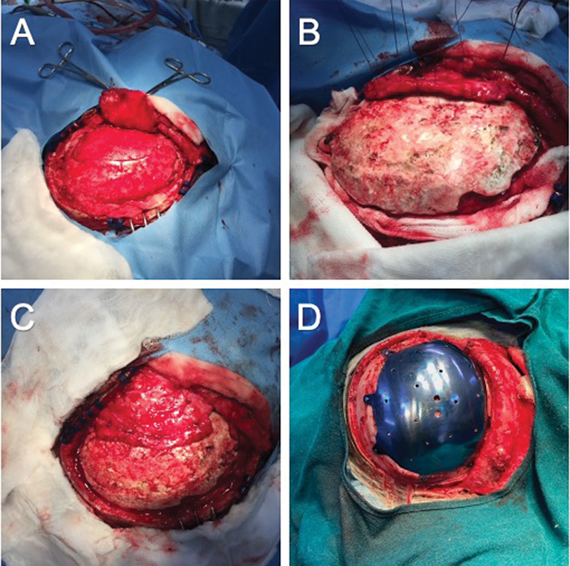 Comparative Analysis of Bite Force after Cranioplasty with and without Temporalis Dissection in Large Skull Defects Caused by Decompressive Craniectomy.