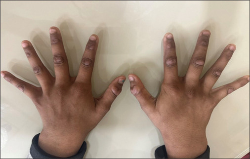 Dermatodaxia or compulsive skin biting.