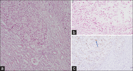 Exploring the Utility of FDG PET-CT in Metastatic Recurrent Extra Skeletal Renal Osteosarcoma.