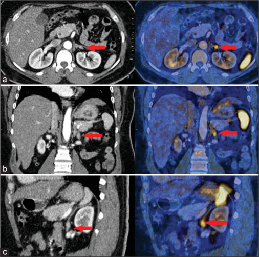 Gallium-68-Pentixafor PET/CT for Subtyping Diagnosis of Primary Aldosteronism: A Pictorial Essay.